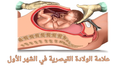 علامة الولادة القيصرية في الشهر الأول